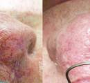 Before and After laser spider vein removal