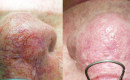 laser-spider-vein-removal-nose-before-and-after