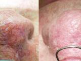 Before and After laser spider vein removal
