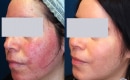 Before and After Laser Treatment for Rosacea