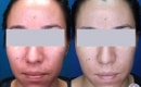 Laser Treatment to Remove Redness on the Face