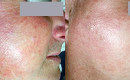 Before and after laser spider vein removal on the face