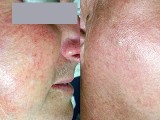 Before and after laser spider vein removal on the face