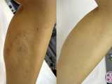 spider-veins-calves-removed-with-laser-treatment