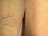 spider-veins-legs-removal-with-laser-treatment
