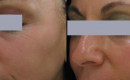 Before and After Collagen Induction Therapy for Wrinkles