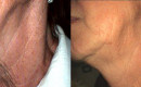 Before and After Collagen Induction Therapy on the Neck