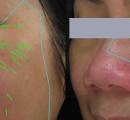 Microneedling treatment before and after patient results.