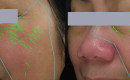 Before and After Collagen Induction Therapy on the Face