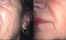 Before and After Collagen Induction Therapy for Wrinkles