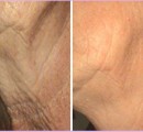 Microneedling can also be performed on the neck as seen in this before and after photo.