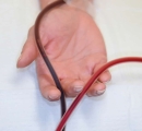 Hand holding the dark outgoing IV and bright red cleansed IV during EBOO /F blood treatment