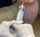 Ozone Injection into the Knee