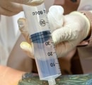 ozone-injection-into-lower-back-ama-regenerative-medicine