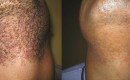 Before and After Beard Laser Hair Removal