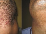 Before and After Beard Laser Hair Removal