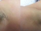 Before and After Under Arm Laser Hair Removal