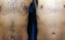 Before and After Chest Laser Hair Removal