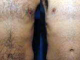 Before and After Chest Laser Hair Removal