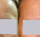 1_scar-removal-laser-treatment-before-and-after