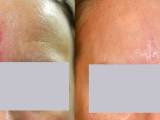 Laser scar removal on the forehead of a patient.