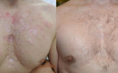 Before and after laser scar removal combined with subcision and stem cells for acne scars on the chest