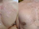 Before and after treatment with lasers for acne scars on the chest