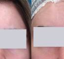 Before and after laser scar removal on the forehead.