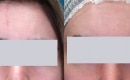 Before and after laser scar removal on the forehead