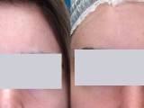 Scar removal on the forehead before and after treatment.