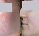 laser-acne-scar-removal