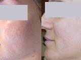 Laser acne scar removal on the check before and after a series treatments.