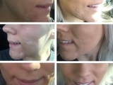 Before and after scar removal on the face using a combination of lasers and stem cells