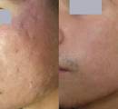 Before and after laser scar removal for acne scars on the face