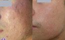 Before and after laser scar removal for acne scars on the face