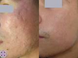 A combination treatment of microneedling and CO2 Fractional Laser to heal acne scars