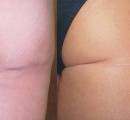 Before and after laser scar treatment for a surgical scar on the leg.