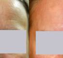 scar-removal-laser-treatment-before-and-after