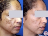 A patient's results before and after laser treatment for melasma.