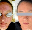 The before and after results of laser treatment for melasma.