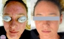 Before and After Laser Treatment for Melasma