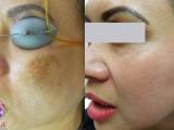 A patient's results with laser melasma removal before and after treatment.