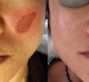 Before and After Laser Treatment for Melasma