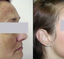 A patient's results with laser melasma removal before and after treatment.