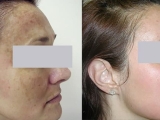 This patient's melasma covered her entire face. It was completely removed with a series of laser treatments.