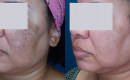 laser-treatment-for-melasma-before-and-after-12