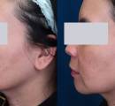 A melasma laser treatment patient's before and after.