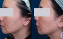 Laser treatment for melasma before and after