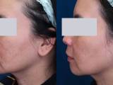 A melasma laser treatment patient's before and after.