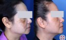 melasma-laser-treatment-before-and-after